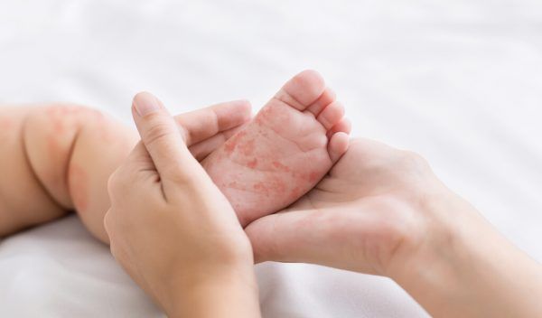 Die Masern sind keine harmlose Kinderkrankheit, sagt Gesundheitslandesrätin Martina Rüscher. Symbolbild/Shutterstock