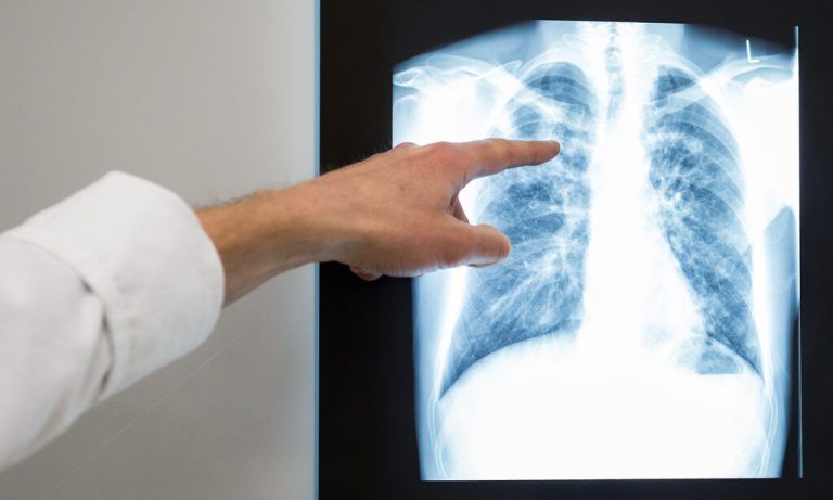 Alle Lungenuntersuchungen der Person mit dem Erreger im Blut blieben unauffällig.⇒⇒Symbolfoto: APA