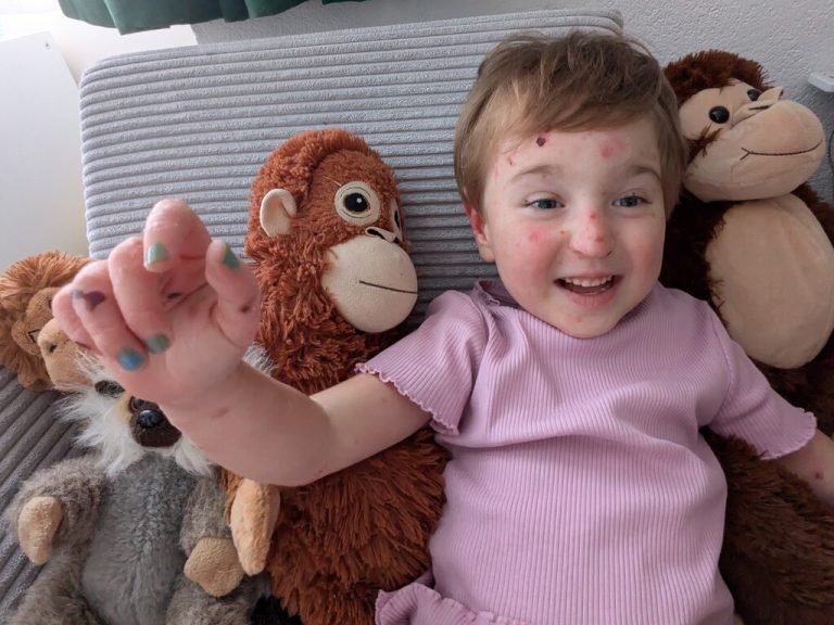 Das dreijährige NEUE-Patenkind Lilijana lebt mit der seltenen „Schmetterlingskrankheit“. Ihre Haut ist extrem empfindlich und braucht täglich aufwendige Pflege. ⇒privat (3), Stiplvosek (2)